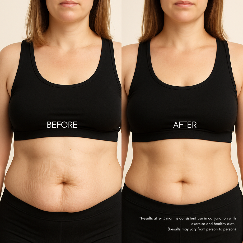 Thermatone Body Sculpting Device